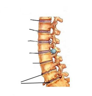 Cum se dezvoltă osteochondroza