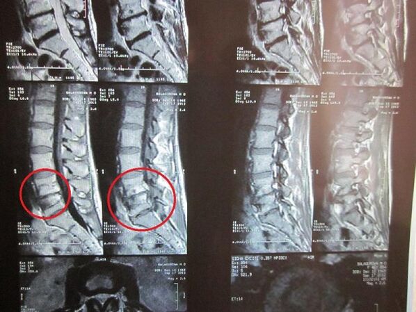 Diagnosticul osteochondrozei cervicale