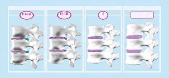 Etapele osteochondrozei cervicale