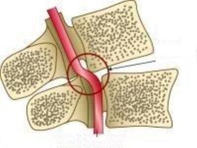 Sindromul arterei Vail