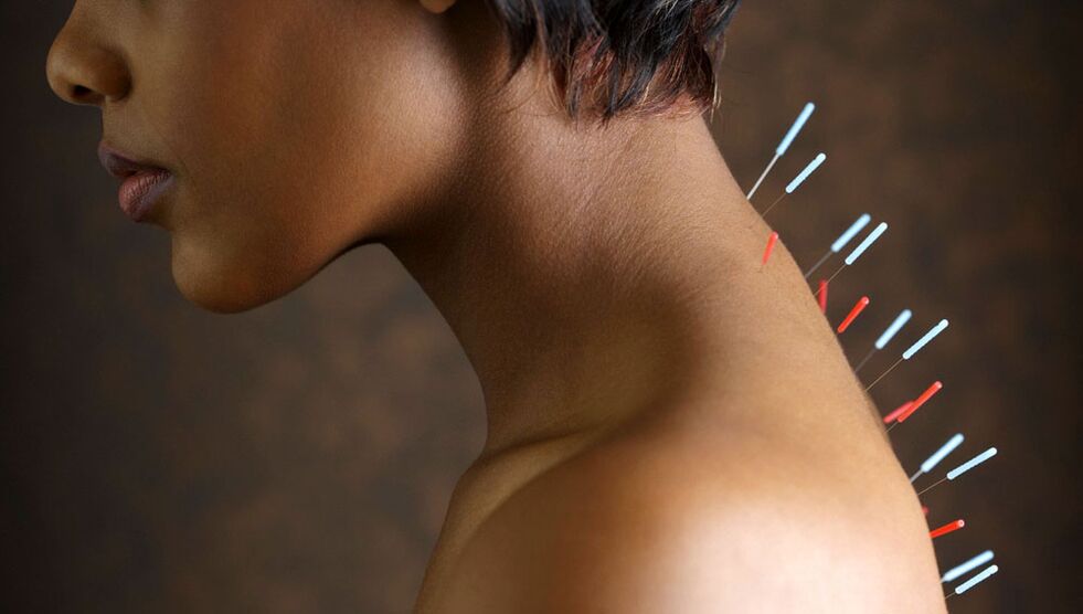 acupunctură cu osteocondroză cervicală