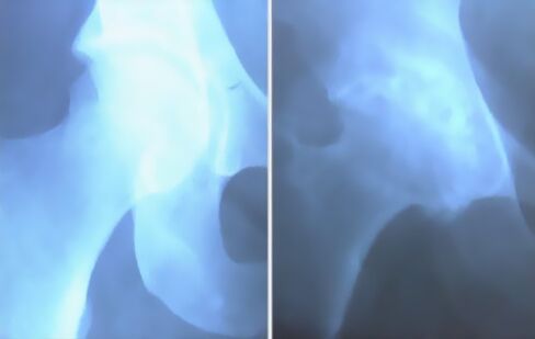 Scrumă de artroză a articulației genunchiului