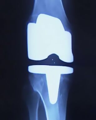 X -RAY Imaginea genunchiului cu o proteză artificială după operație pentru a schimba articulația