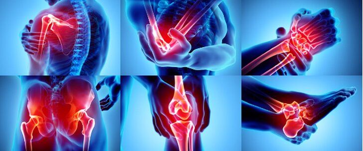 Articulații inflamate