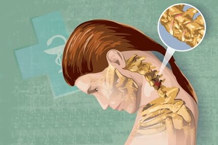 Simptome reflexe ale osteochondrozei